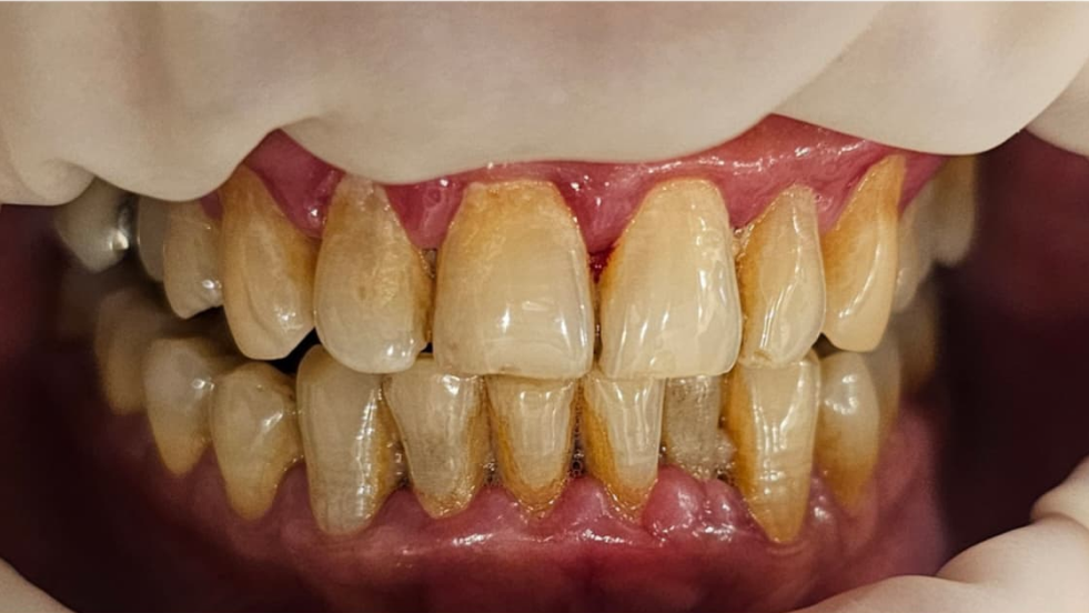 Severe tartar buildup on teeth with yellow staining and inflamed gums, showing signs of gum disease and poor oral hygiene.