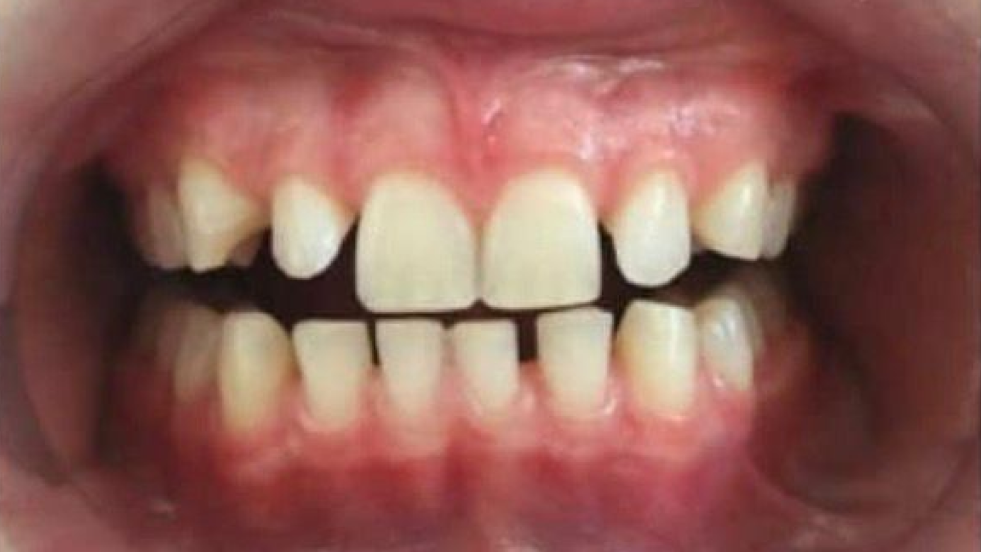 Teeth with gaps and uneven alignment, showing dental spacing issues and need for orthodontic treatment.