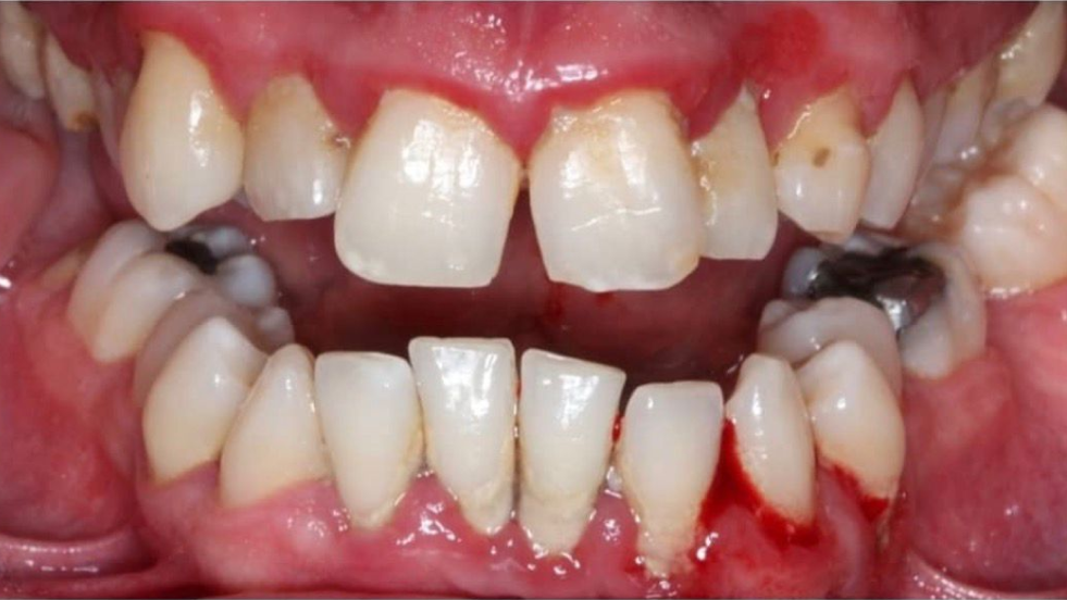 Before dental treatment showing inflamed gums, bleeding, uneven teeth, and dental decay indicating poor oral health.