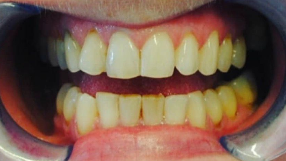Before teeth whitening showing yellow stained teeth and plaque buildup near the gums.