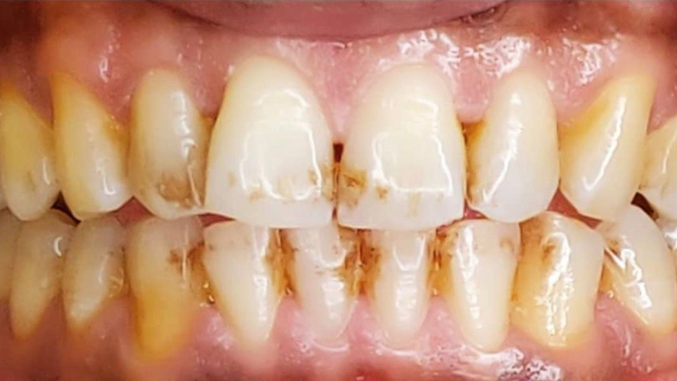 Before dental cleaning showing heavy tartar buildup, brown stains on teeth, and poor oral hygiene.