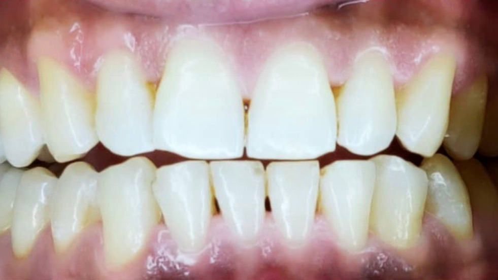 After dental cleaning and whitening showing clean, bright teeth with improved gum health.