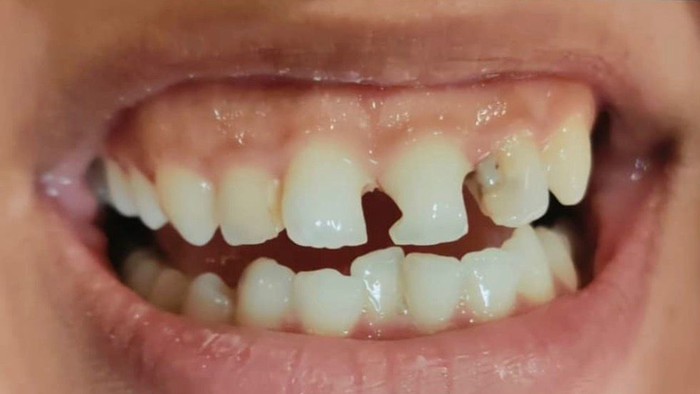Before smile correction showing chipped front teeth, uneven alignment, and dental gaps.