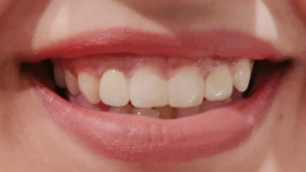 After smile makeover showing aligned, natural-looking teeth with an improved smile.